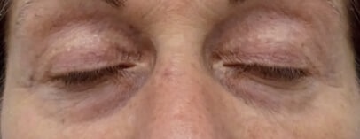 ICOONE® Laser MED – Gesicht: nach der Behandlung, Ergebnis 1