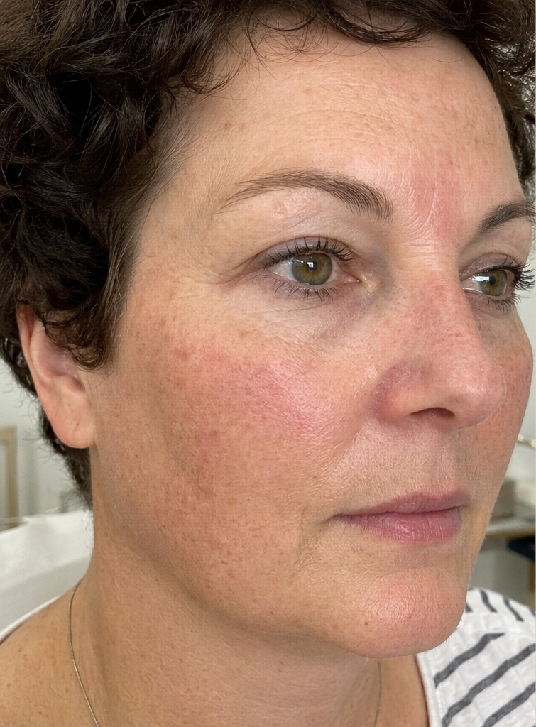 Cosmelan®: vor der Behandlung, Ergebnis 1
