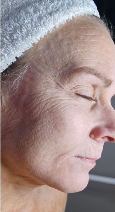 HydraFacial®: vor der Behandlung, Ergebnis 1