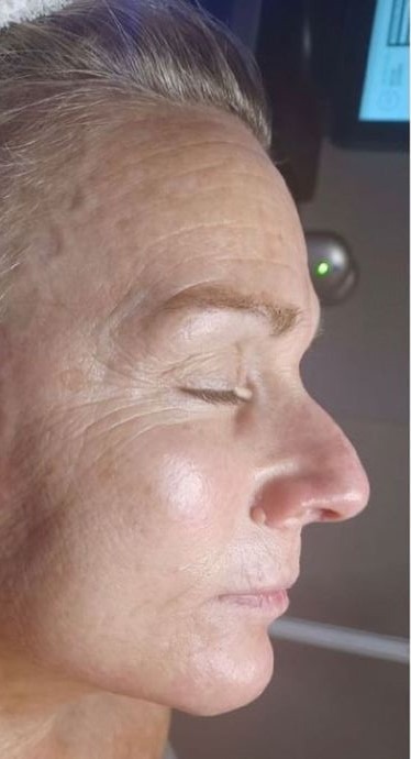 HydraFacial®: nach der Behandlung, Ergebnis 1