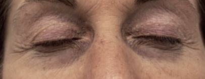ICOONE® Laser MED – Gesicht: vor der Behandlung, Ergebnis 1