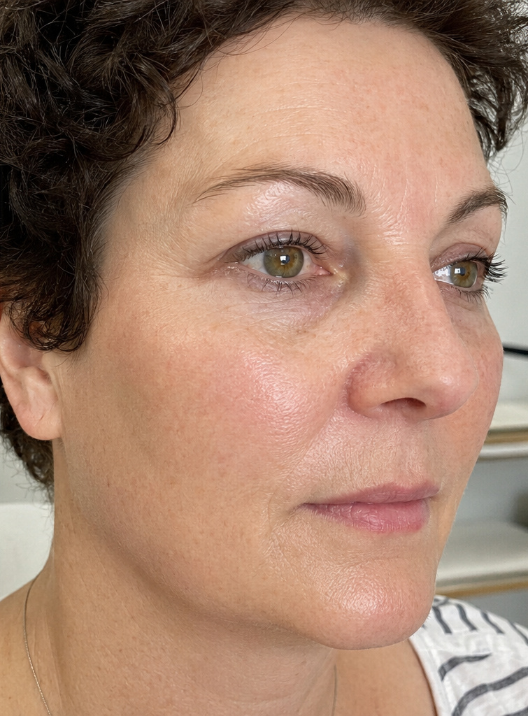 Cosmelan®: nach der Behandlung, Ergebnis 1